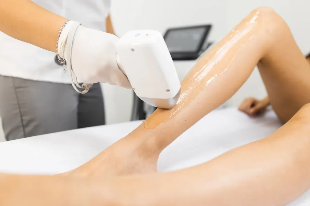 Woman getting laser hair removal treatments on her legs